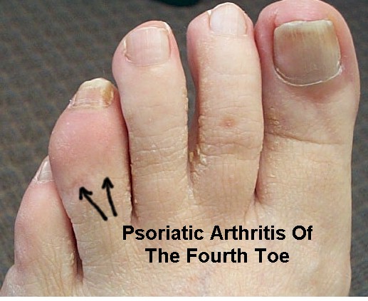 sharp-pain-in-feet-symptoms-of-arthritis-in-toes-sapna-pain